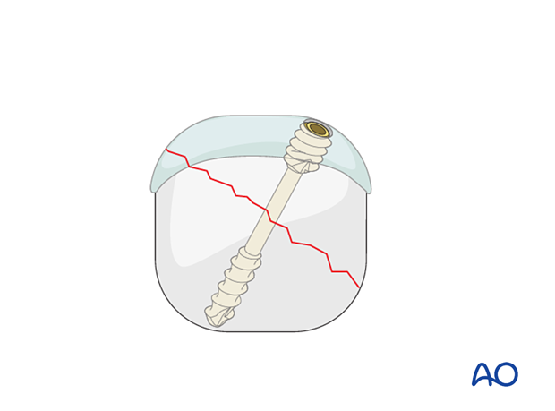 Compression of an articular fracture with a headless compression screw