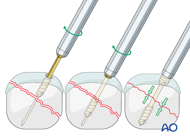 Insertion of a headless screw for extrinsic compression of an articular fracture