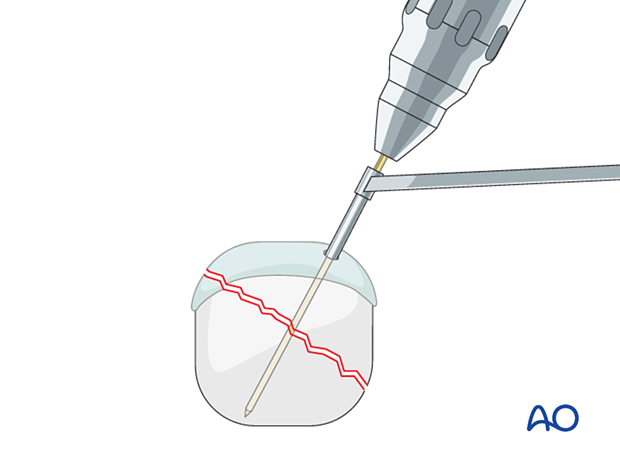 Compression of an articular fracture with a headless compression screw – Guide-wire insertion