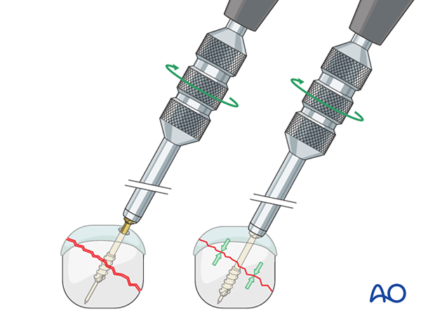 Compression of an articular fracture with a headless compression screw – Screw insertion with a compression sleeve