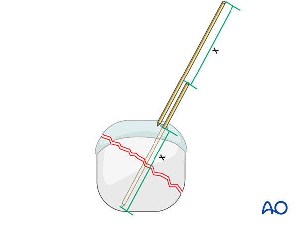 Compression of an articular fracture with a headless compression screw – Screw-length determination