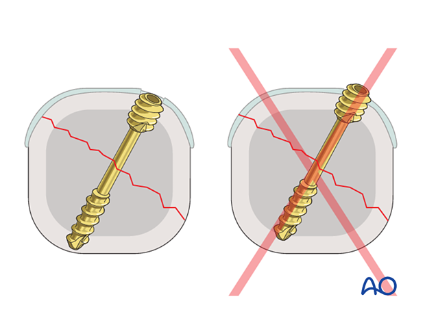 Compression of an articular fracture with a headless compression screw – Ensuring the screw head is fully buried in the bone