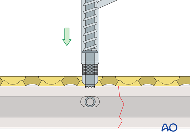 spring-loaded LC-DCP drill guide