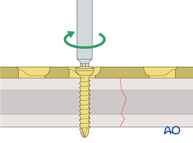 Screw insertion