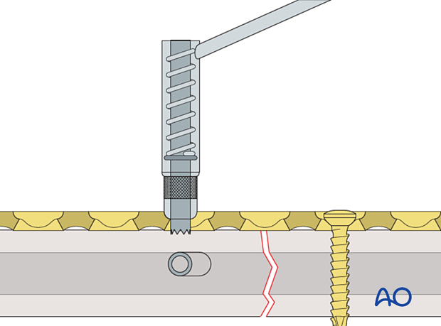 universal spring-loaded DCP drill guide