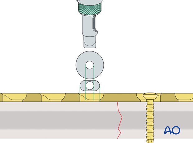 DCP drill guide