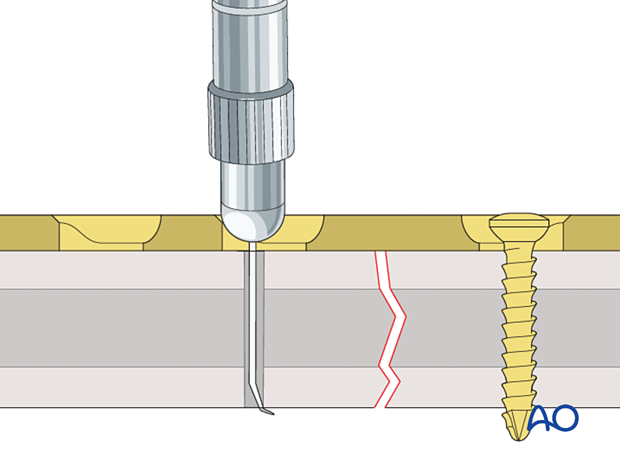 Determination of screw length