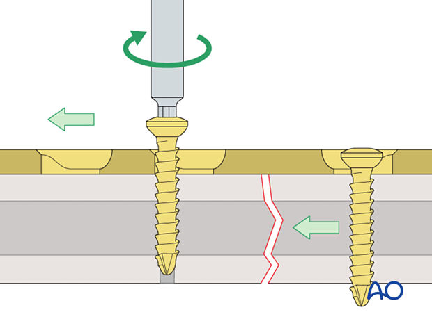 Compression of fracture