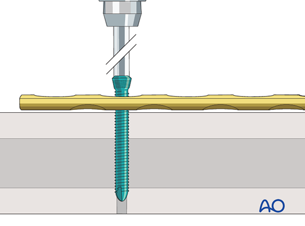 Screw insertion