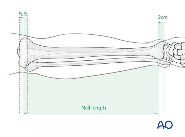 Determination of nail lenght