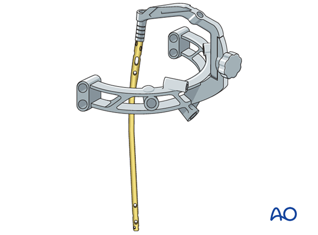 Mounting of nail on introduction handle