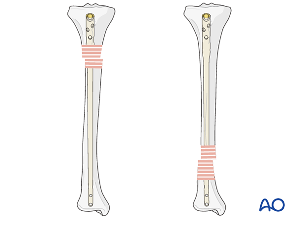 Angular displacement of nail tip