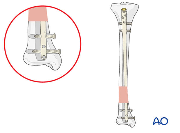 Displacement along screw axis of parallel screws