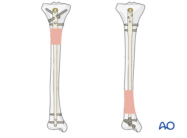 Insertion of screws in different axis