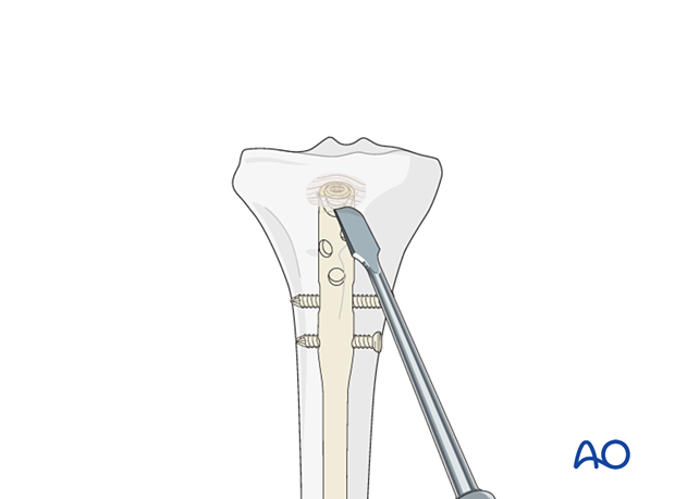 Removal of bone covering endcap