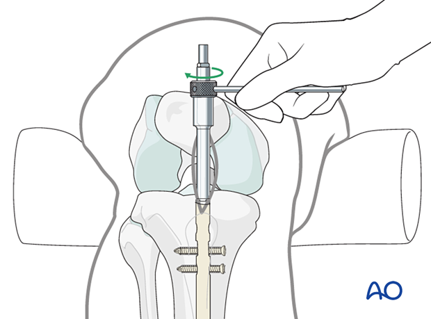 Attachment of extraction device