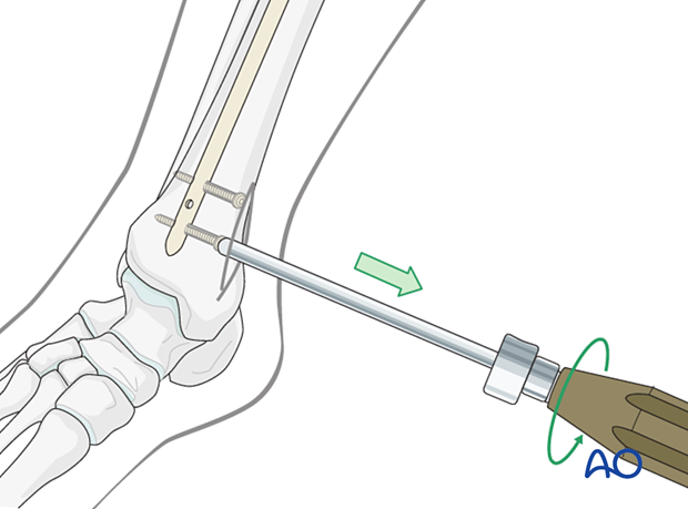 Removal of locking screws and nail removal