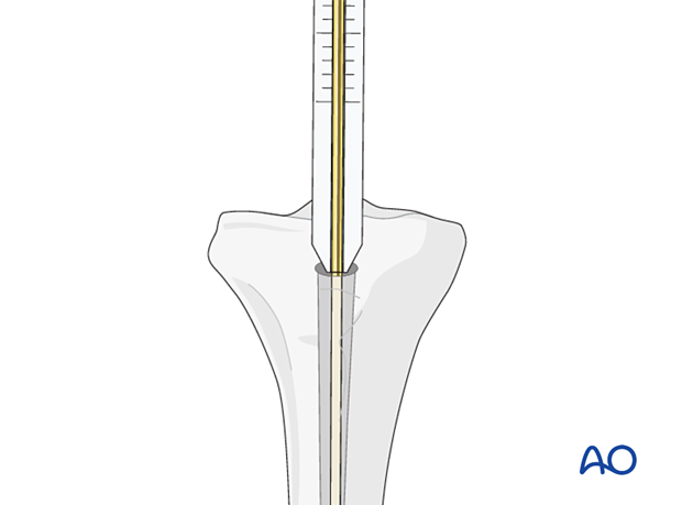 Determination of nail length using a depth gauge