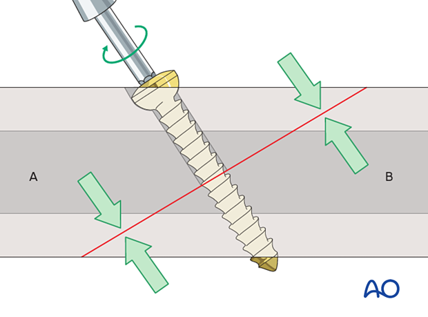 Lag screw compressing the fracture