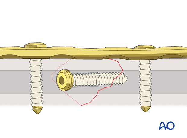 Lag screw with neutralization device