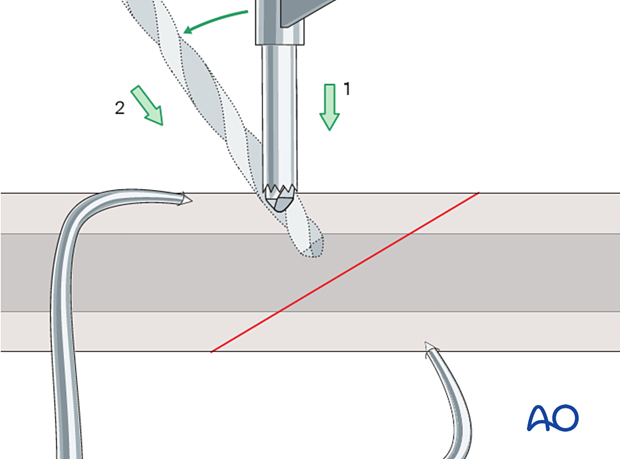 Pearl for drilling obliquely to the surface of the bone