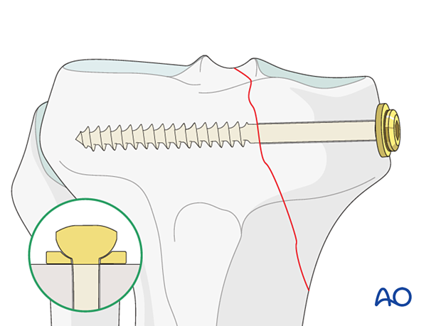 cancellous lag screws