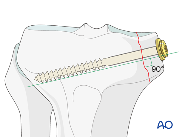 cancellous lag screws