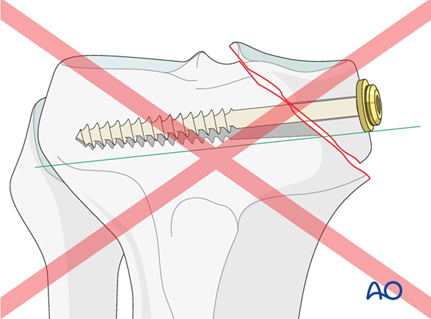 cancellous lag screws