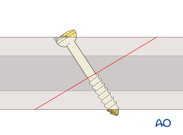 Screw insertion