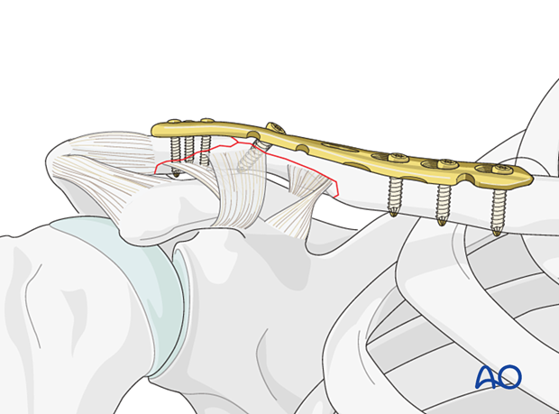 Precontoured plate