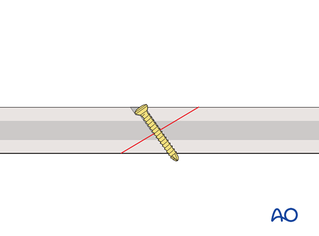 Lag screw fixation