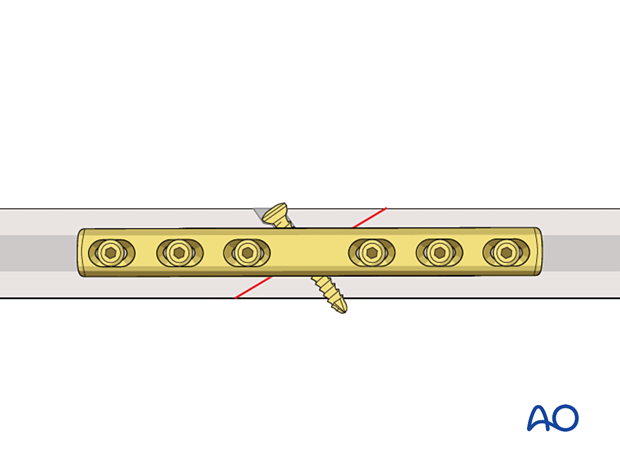 Lag screw fixation protected by a neutralization plate