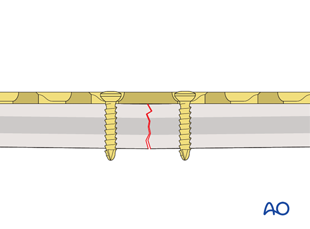 Plate applied with fracture gap of the far cortex