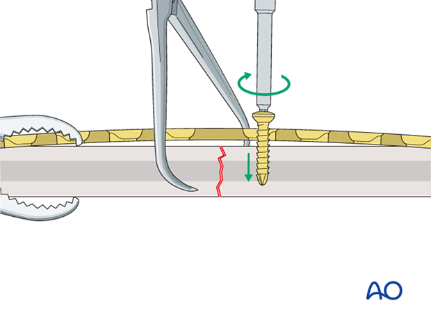 Insertion of first compression screw