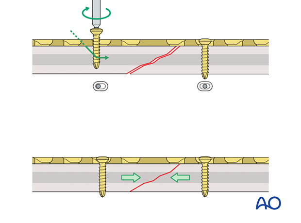 Compression plating of an oblique shaft fracture