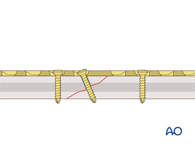 Insertion of lag screw