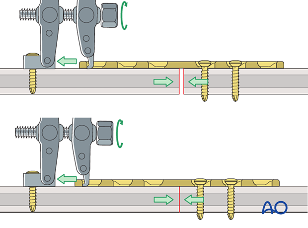 Compression using articulated tension device