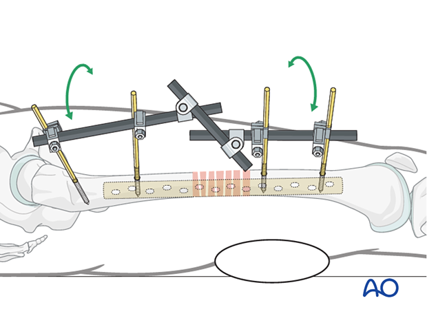 Use of external fixation