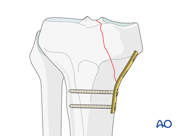 Plate fixation