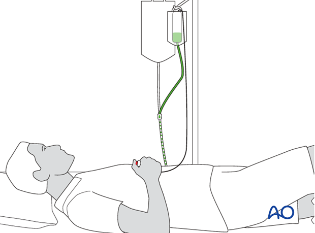 Compartment syndrome is a true surgical emergency. 