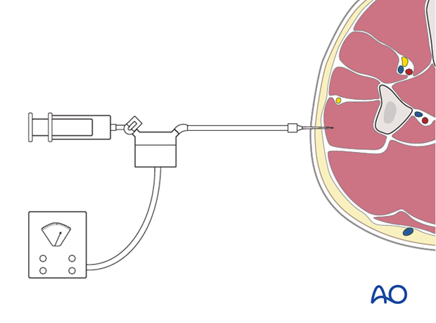 When the diagnosis is unclear, or possibly absent, compartment pressure measurement may be confirmatory, or prevent...