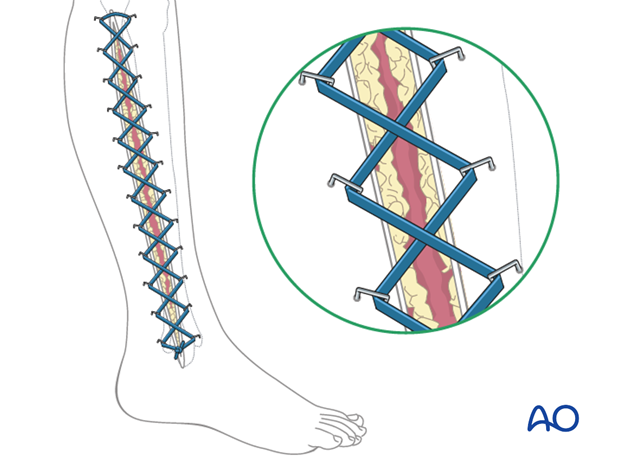 Once any skeletal injury is under control, the fasciotomy wound(s) healthy and the swelling of the soft tissues has...