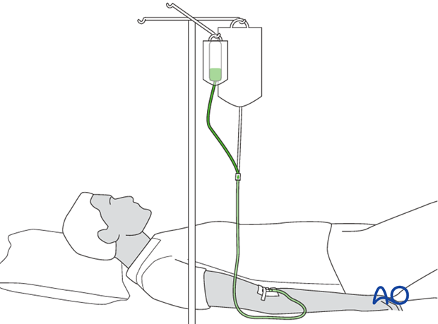 Intravenous antibiotics for open fractures