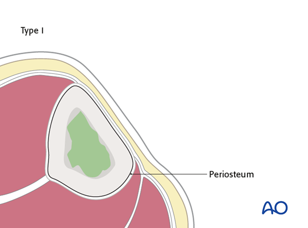 Medullary osteomyelitis (type I)