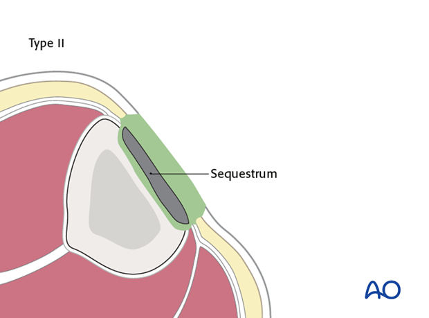 Superficial osteomyelitis (type II) 