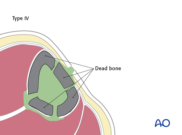 Diffuse osteomyelitis (type IV) 