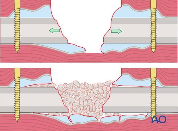 Autogenous cancellous bone graft, harvested from any standard donor site is the material of choice for promoting union...