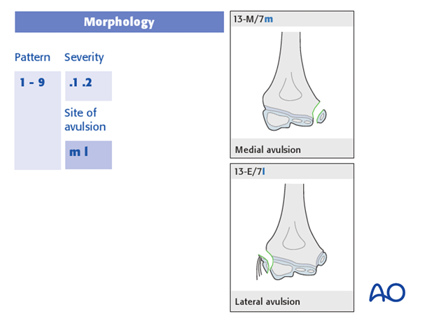 classification of childrens fractures