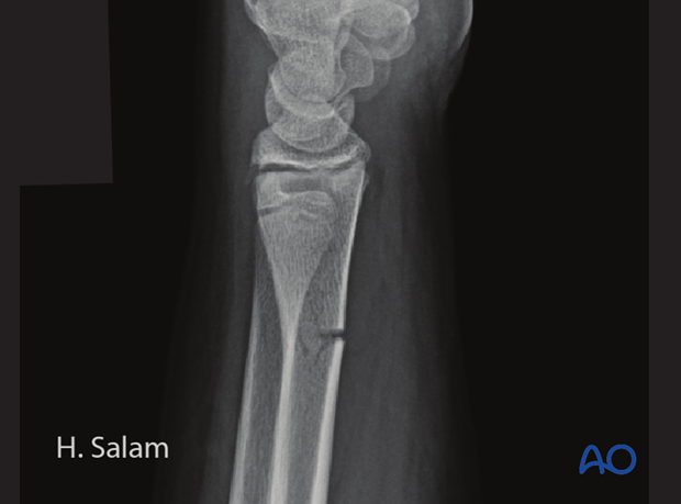 principles of nonoperative treatment of childrens fractures