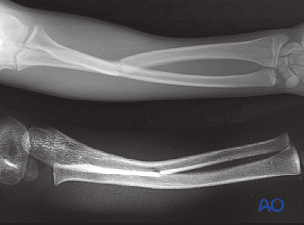 principles of nonoperative treatment of childrens fractures